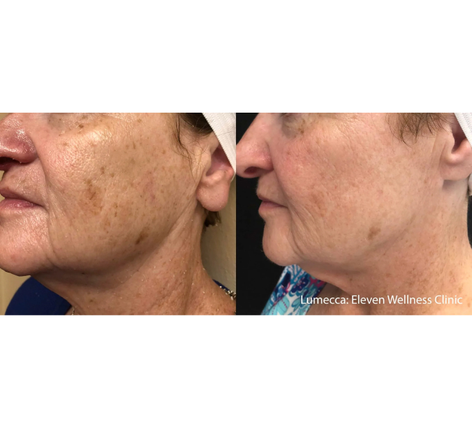 Old Female Before and After Getting Lumecca IPL Photofacial treatments | Aspen Prime Med Spa in Hoboken, NJ