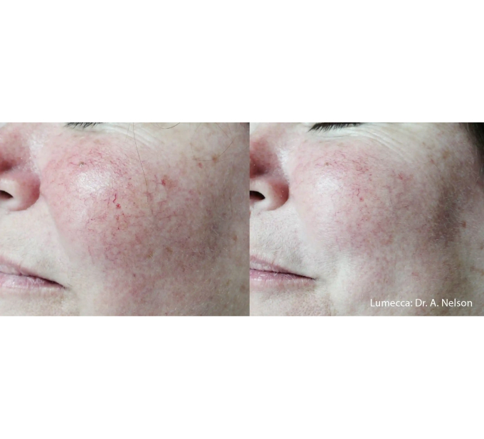 Old Female Before and After Getting Lumecca IPL Photofacial treatments | Aspen Prime Med Spa in Hoboken, NJ