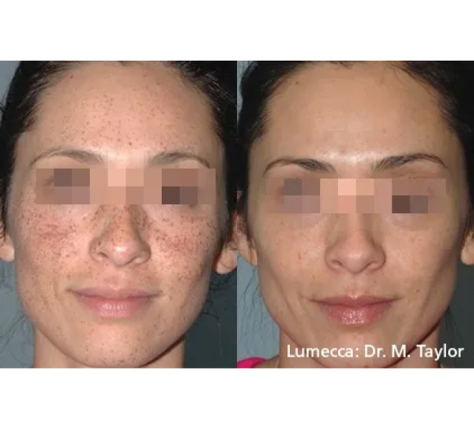 Young Female Before and After Getting Lumecca IPL Photofacial treatments | Aspen Prime Med Spa in Hoboken, NJ