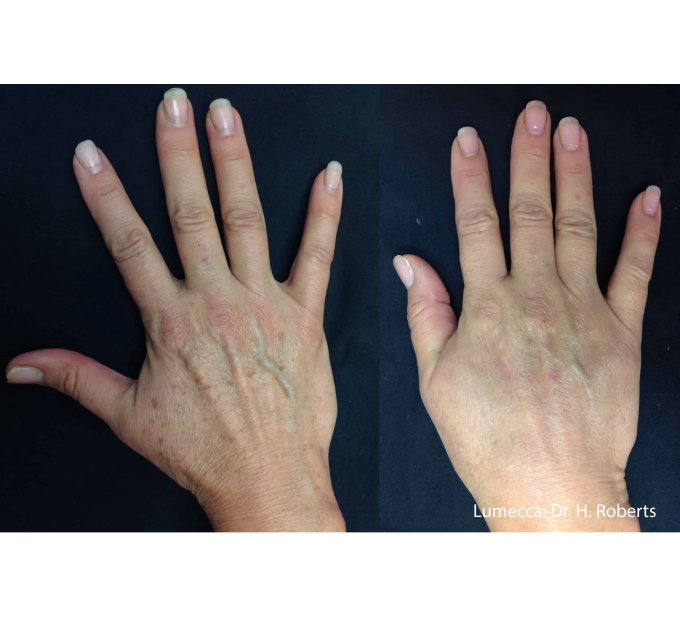 Old Female Hand Before and After Getting Lumecca IPL Photofacial treatments | Aspen Prime Med Spa in Hoboken, NJ