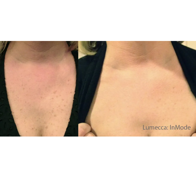 Old Female Chest Before and After Getting Lumecca IPL Photofacial treatments | Aspen Prime Med Spa in Hoboken, NJ