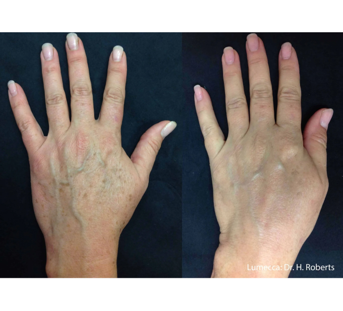 Old Female Hand Before and After Getting Lumecca IPL Photofacial treatments | Aspen Prime Med Spa in Hoboken, NJ