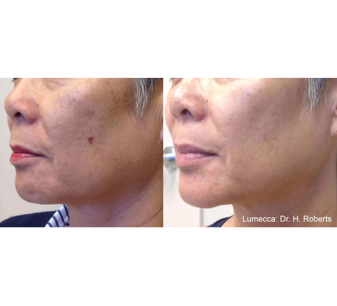 Old Female Before and After Getting Lumecca IPL Photofacial treatments | Aspen Prime Med Spa in Hoboken, NJ