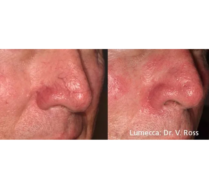 Old Female Nose Before and After Getting Lumecca IPL Photofacial treatments | Aspen Prime Med Spa in Hoboken, NJ
