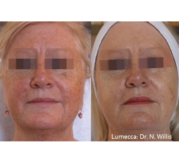 Old Female Before and After Getting Lumecca IPL Photofacial treatments | Aspen Prime Med Spa in Hoboken, NJ