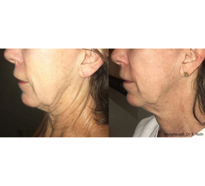Old Female Before and After Getting Morpheus8 RF Microneedling Optimas laser treatments | Aspen Prime Med Spa in Hoboken, NJ