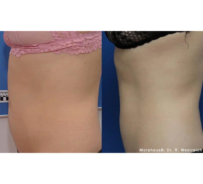 Young Female Before and After Getting Morpheus8 RF Microneedling Optimas laser treatments | Aspen Prime Med Spa in Hoboken, NJ