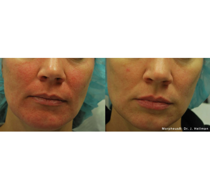 Optimas Morpheus8 Treatment Before and After Photos | Aspen Prime MedSpa in Hoboken, NJ