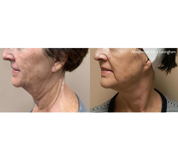 Optimas Morpheus8 Treatment Before and After Photos | Aspen Prime MedSpa in Hoboken, NJ