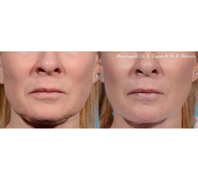 Optimas Morpheus8 Treatment Before and After Photos | Aspen Prime MedSpa in Hoboken, NJ