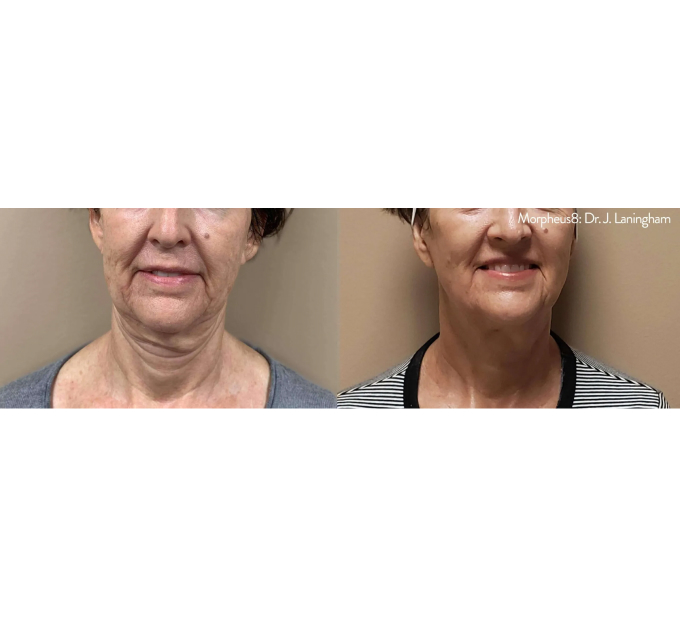 Optimas Morpheus8 Treatment Before and After Photos | Aspen Prime MedSpa in Hoboken, NJ