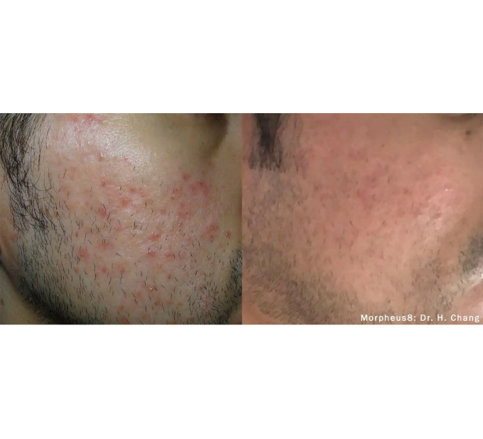 Optimas Morpheus8 Treatment Before and After Photos | Aspen Prime MedSpa in Hoboken, NJ