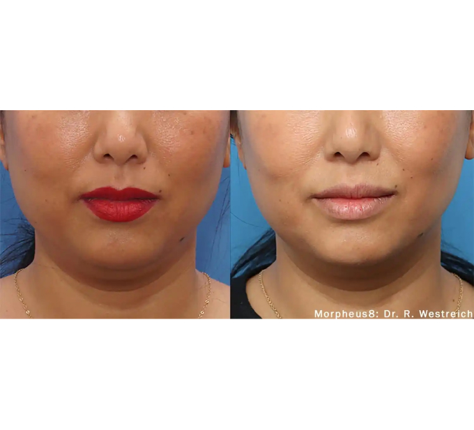 Optimas Morpheus8 Treatment Before and After Photos | Aspen Prime MedSpa in Hoboken, NJ