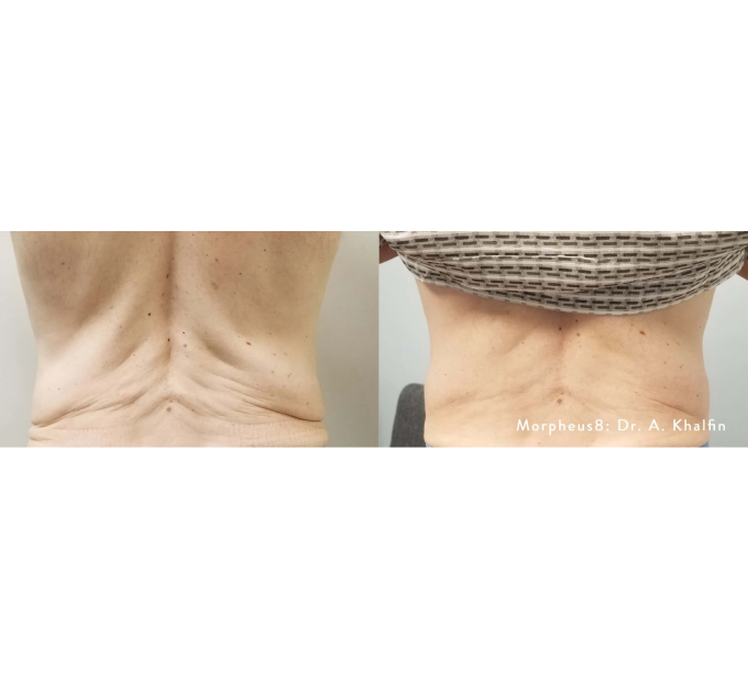 Optimas Morpheus8 Treatment Before and After Photos | Aspen Prime MedSpa in Hoboken, NJ