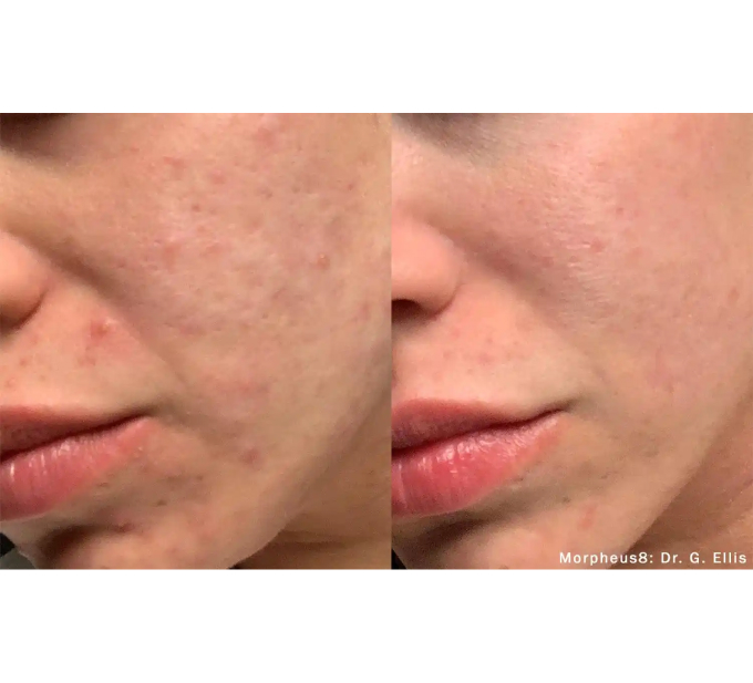 Optimas Morpheus8 Treatment Before and After Photos | Aspen Prime MedSpa in Hoboken, NJ