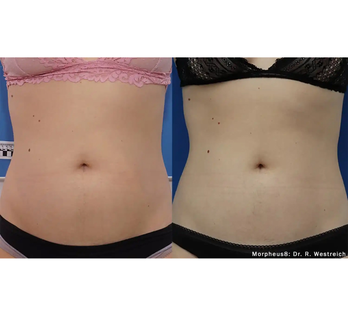 Optimas Morpheus8 Treatment Before and After Photos | Aspen Prime MedSpa in Hoboken, NJ