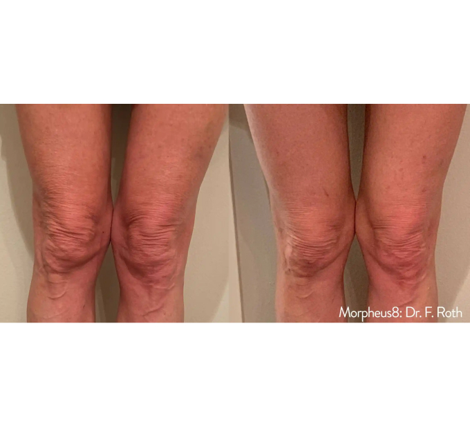 Optimas Morpheus8 Treatment Before and After Photos | Aspen Prime MedSpa in Hoboken, NJ
