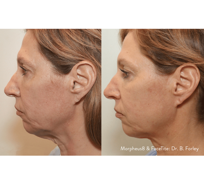Optimas Morpheus8 Treatment Before and After Photos | Aspen Prime MedSpa in Hoboken, NJ