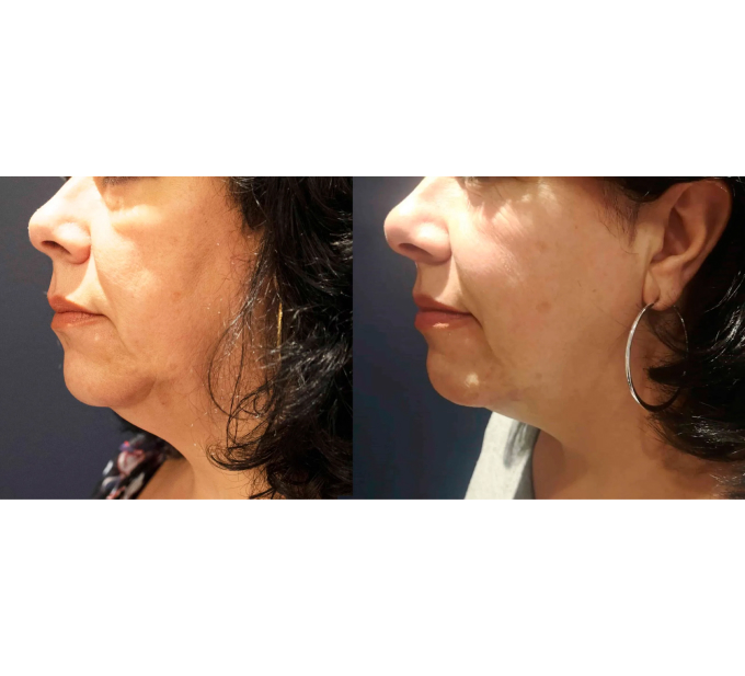 Optimas Morpheus8 Treatment Before and After Photos | Aspen Prime MedSpa in Hoboken, NJ