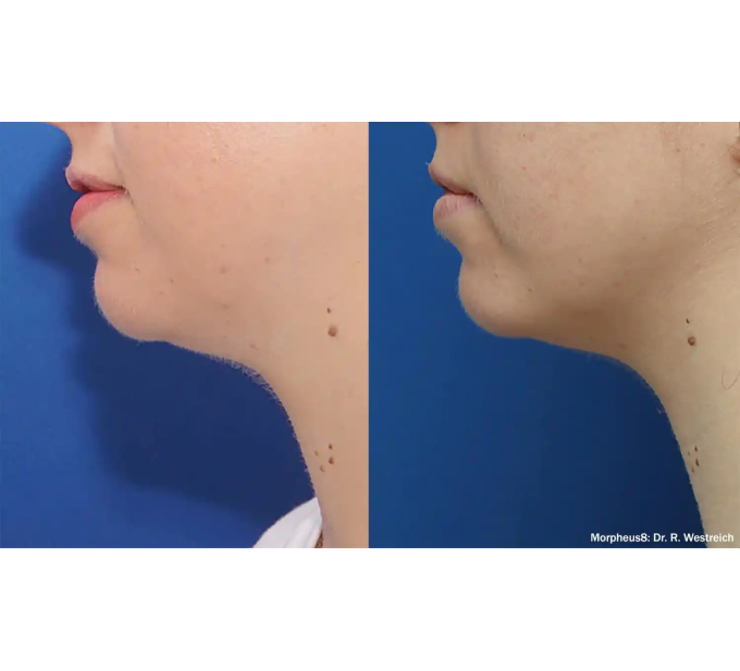 Optimas Morpheus8 Treatment Before and After Photos | Aspen Prime MedSpa in Hoboken, NJ