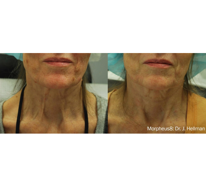 Optimas Morpheus8 Treatment Before and After Photos | Aspen Prime MedSpa in Hoboken, NJ
