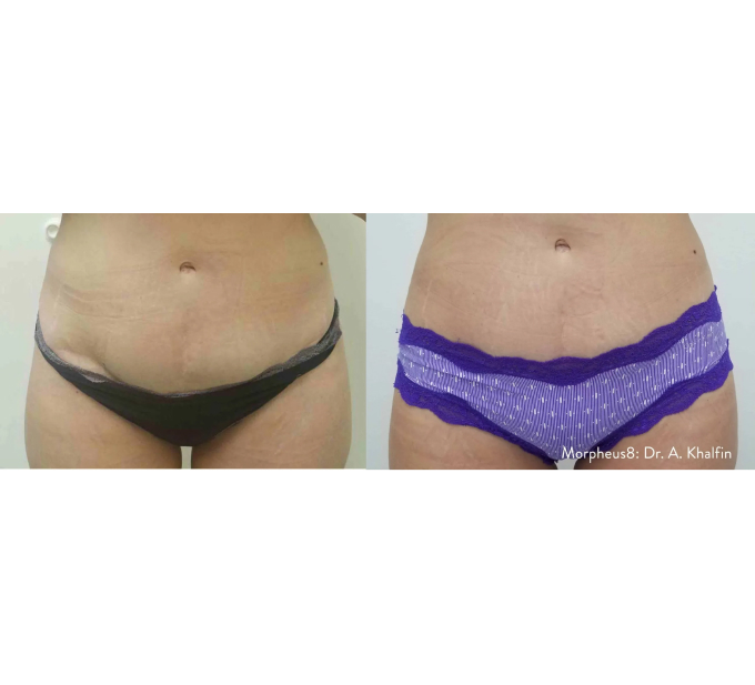 Optimas Morpheus8 Treatment Before and After Photos | Aspen Prime MedSpa in Hoboken, NJ