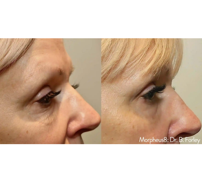 Optimas Morpheus8 Treatment Before and After Photos | Aspen Prime MedSpa in Hoboken, NJ