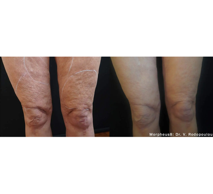 Optimas Morpheus8 Treatment Before and After Photos | Aspen Prime MedSpa in Hoboken, NJ
