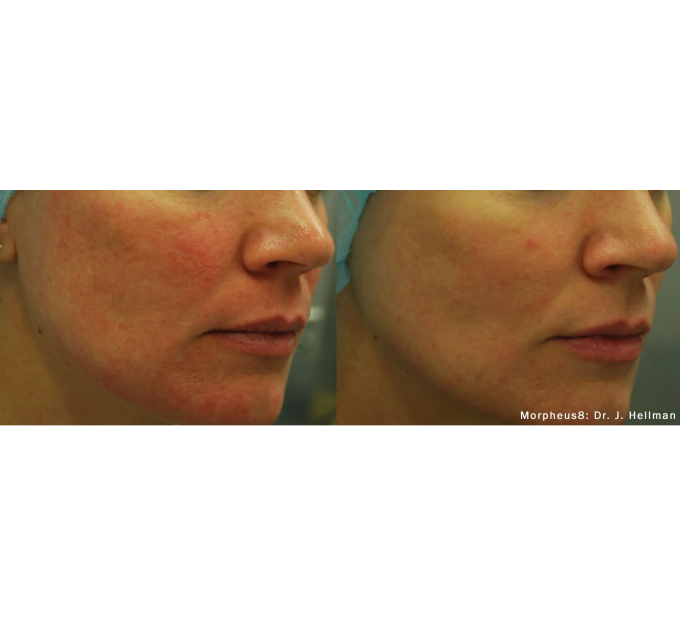 Optimas Morpheus8 Treatment Before and After Photos | Aspen Prime MedSpa in Hoboken, NJ