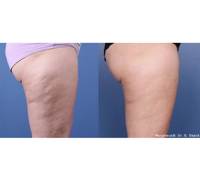 Optimas Morpheus8 Treatment Before and After Photos | Aspen Prime MedSpa in Hoboken, NJ