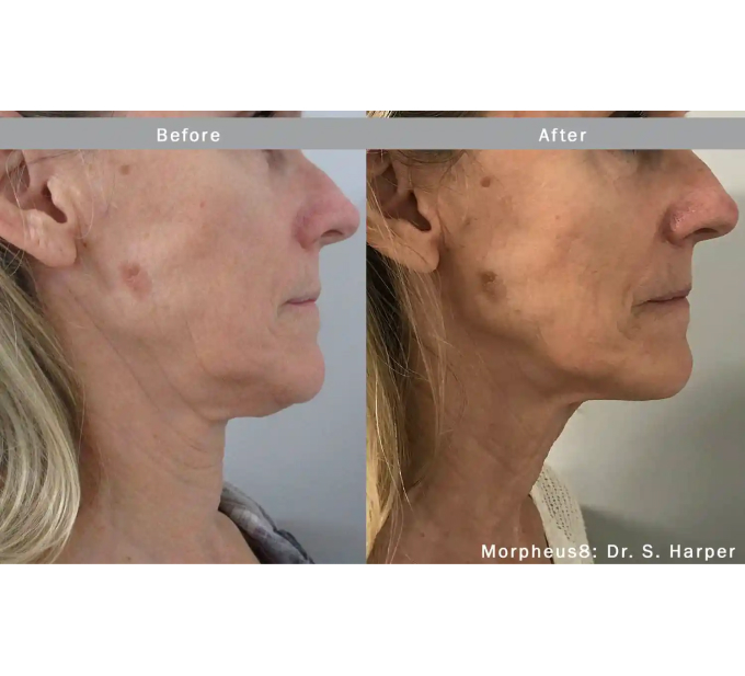 Optimas Morpheus8 Treatment Before and After Photos | Aspen Prime MedSpa in Hoboken, NJ