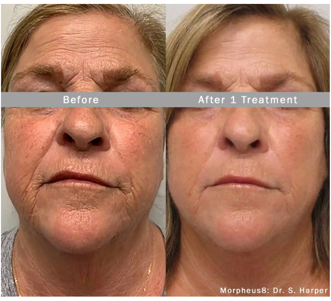 Optimas Morpheus8 Treatment Before and After Photos | Aspen Prime MedSpa in Hoboken, NJ