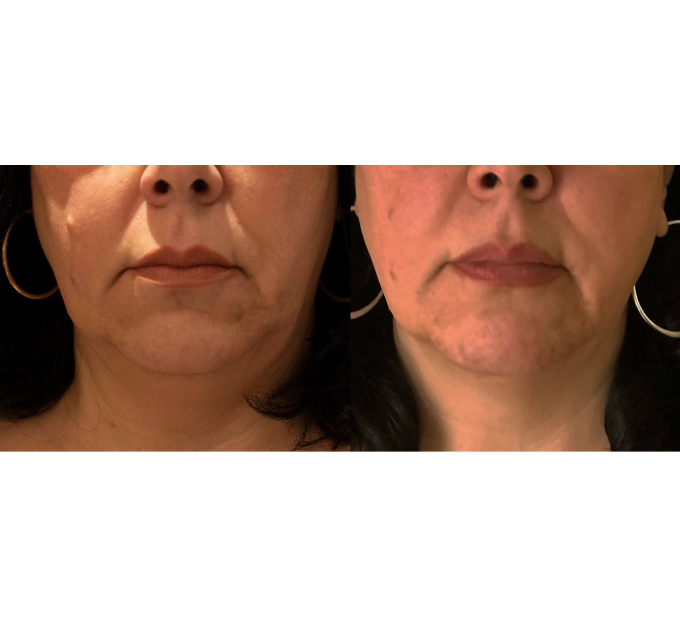 Optimas Morpheus8 Treatment Before and After Photos | Aspen Prime MedSpa in Hoboken, NJ
