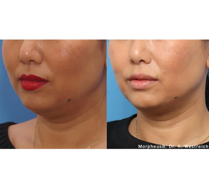 Optimas Morpheus8 Treatment Before and After Photos | Aspen Prime MedSpa in Hoboken, NJ