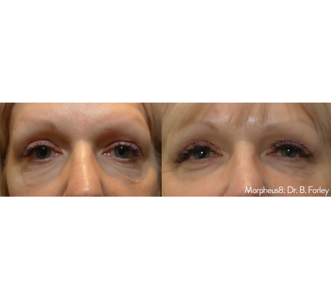 Optimas Morpheus8 Treatment Before and After Photos | Aspen Prime MedSpa in Hoboken, NJ