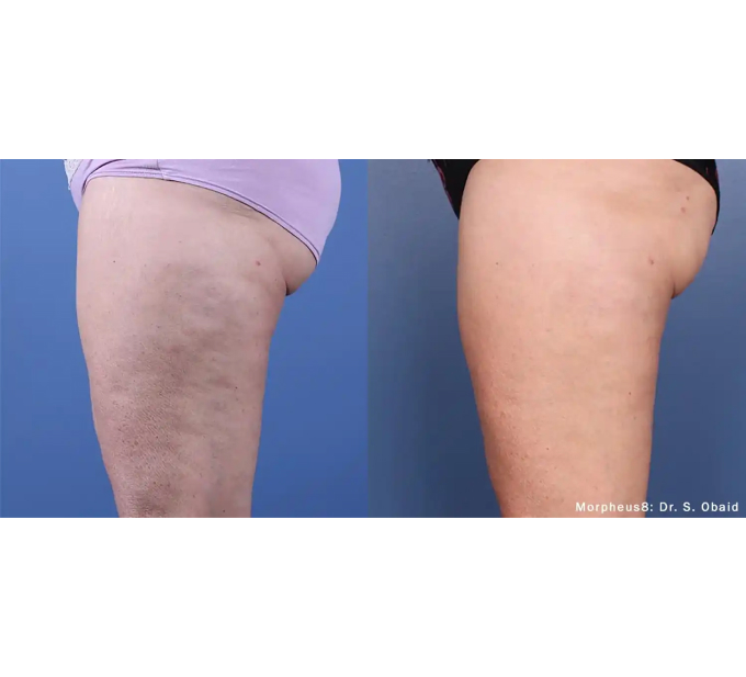 Optimas Morpheus8 Treatment Before and After Photos | Aspen Prime MedSpa in Hoboken, NJ