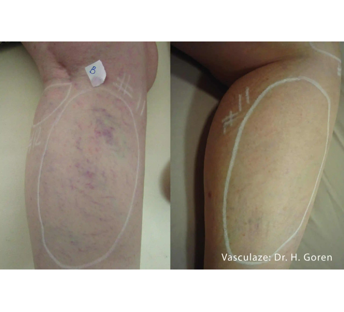 Optimas Vasculaze Treatment Before and After Leg Photos | Aspen Prime MedSpa in Hoboken, NJ