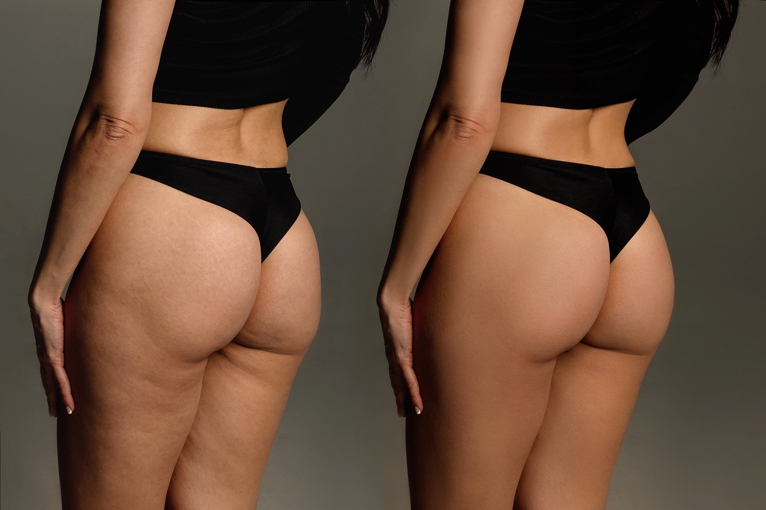 before and after liposuction procedure and cosmetic therapy | Aspen Prime Med Spa in Hoboken, NJ
