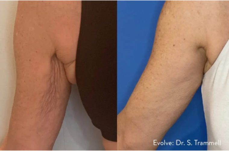 EvolveX Treatment Before and After Image | Aspen Prime Med Spa in Hoboken, NJ