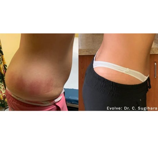 EvolveX treatment Before and After Image | Aspen Prime Med Spa in Hoboken, NJ