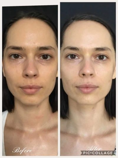 Before and After JetPeel Treatment Results on a Woman's Face | Aspen Prime Med Spa in Hoboken, NJ