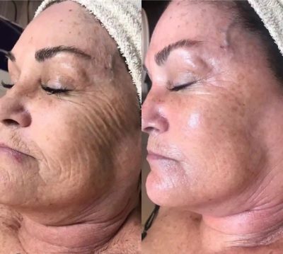Before and After JetPeel Treatment Results on a woman face | Aspen Prime Med Spa in Hoboken, NJ