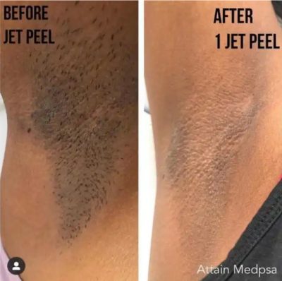 Before and After JetPeel Treatment Results on the under arms | Aspen Prime Med Spa in Hoboken, NJ