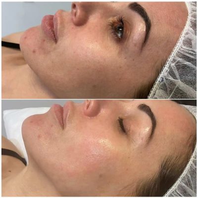 Before and After JetPeel Treatment Results on the eyes of a woman | Aspen Prime Med Spa in Hoboken, NJ