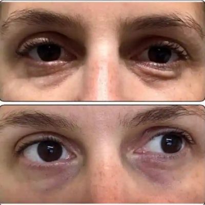 Before and After JetPeel Treatment Results on the eyes | Aspen Prime Med Spa in Hoboken, NJ
