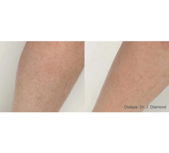 Young Female Leg Before and After Getting Diazole XL Hair Removal treatments | Aspen Prime Med Spa in Hoboken, NJ