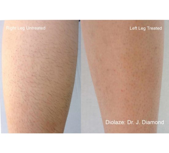Young Female Leg Before and After Getting Lumecca IPL Photofacial treatments | Aspen Prime Med Spa in Hoboken, NJ