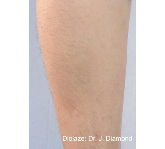 Young Female Leg Before Getting Lumecca IPL Photofacial treatments. Untreated | Aspen Prime Med Spa in Hoboken, NJ