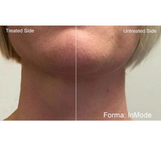 Old Female Face Before and After Forma treatments | Aspen Prime Med Spa in Hoboken, NJ