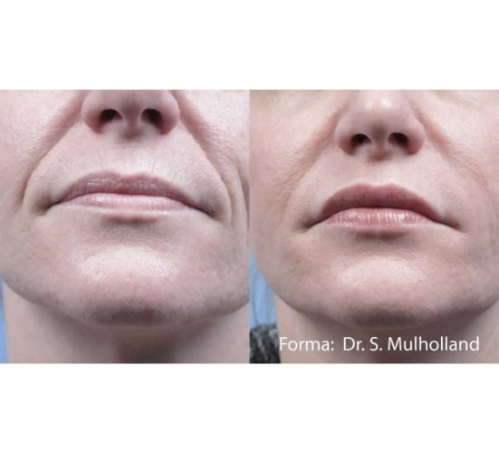 Old Female Face Before and After Forma treatments | Aspen Prime Med Spa in Hoboken, NJ